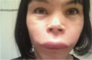Face swelling during a hereditary angioedema (HAE) attack
