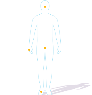 Hereditary Angioedema (HAE) attack locations