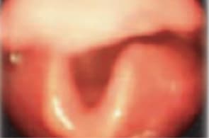 Throat without a hereditary angioedema (HAE) or laryngeal attack
