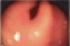 Throat swelling during a hereditary angioedema (HAE) or laryngeal attack